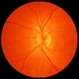 Syphilitic Optic Neuritis After Treatment Syphilitic Optic Neuritis After Treatment