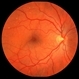 Chronic Retinal Detachment Chronic Retinal Detachment