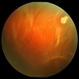 Acute Retinal Detachment Acute Retinal Detachment