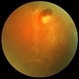 Operculated Retinal Hole Operculated Retinal Hole