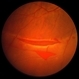 Acute Retinal Detachment Acute Retinal Detachment