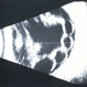 Chronic Retinal Detachment Chronic Retinal Detachment