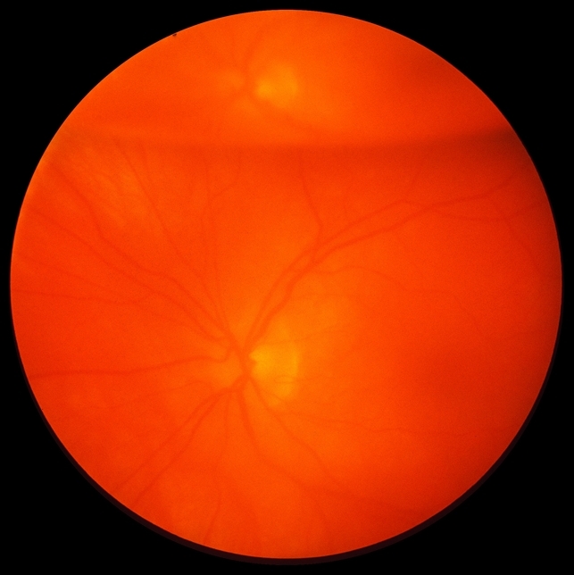 Intravitreal Gas Bubble After PPV Retina Image Bank intravitreal-gas-bubble-after-ppv-retina-image-bank