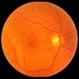 Retinoschisis Retinoschisis