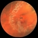 Subclinical Retinal Detachment Subclinical Retinal Detachment