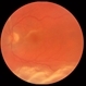 Chronic Total Retinal Detachment Chronic Total Retinal Detachment