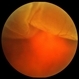 Acute Superior Retinal Detachment Acute Superior Retinal Detachment