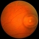 Trapped Subretinal Gas Bubble Trapped Subretinal Gas Bubble