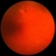 Operculated Retinal Hole in Retinal Detachment Operculated Retinal Hole in Retinal Detachment