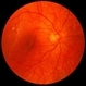 Retinal Detachment with Macula Partially Detached Retinal Detachment with Macula Partially Detached