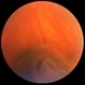 Retinal Tear on Radial Scleral Buckle Retinal Tear on Radial Scleral Buckle