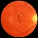 Submacular Choroidal Neovascularization Submacular Choroidal Neovascularization