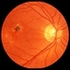 Submacular Choroidal Neovascularization Submacular Choroidal Neovascularization