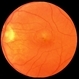 Presumed Ocular Histoplasmosis Syndrome with Submacular CNV CF Presumed Ocular Histoplasmosis Syndrome with Submacular CNV CF