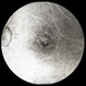Presumed Ocular Histoplasmosis Syndrome with Submacular CNV Presumed Ocular Histoplasmosis Syndrome with Submacular CNV