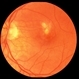 Presumed Ocular Histoplasmosis Syndrome  with Submacular CNV Presumed Ocular Histoplasmosis Syndrome  with Submacular CNV