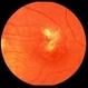 Presumed Ocular Histoplasmosis Syndrome with Submacular CNV Presumed Ocular Histoplasmosis Syndrome with Submacular CNV