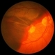 Massive Subretinal Hemorrhage in ARMD