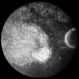 ARMD s/p Surgical Removal of Massive Subretinal Hemorrhage ARMD s/p Surgical Removal of Massive Subretinal Hemorrhage