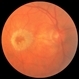 Perifoveal Laser in ARMD Perifoveal Laser in ARMD