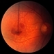 ARMD with Subfoveal CNV ARMD with Subfoveal CNV