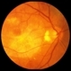 ARMD with Large Macular Scar ARMD with Large Macular Scar