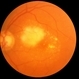 Juxtafoveal CNV in ARMD Juxtafoveal CNV in ARMD