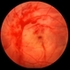 Traumatic Retinal Hemorrhage Traumatic Retinal Hemorrhage