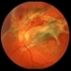 Traumatic Chorioretinal Scarring Traumatic Chorioretinal Scarring
