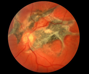 scar in eye retina scar in eye retina