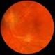 Proliferative Diabetic Retinopathy with Macular Traction Proliferative Diabetic Retinopathy with Macular Traction