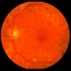 Proliferative Diabetic Retinopathy with Macular Traction Proliferative Diabetic Retinopathy with Macular Traction