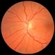 Diamond Dust from Retinal Scraper Diamond Dust from Retinal Scraper