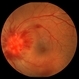 Sarcoid Optic Neuropathy with Retinal Hemorrhages Sarcoid Optic Neuropathy with Retinal Hemorrhages
