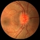 Sarcoid Optic Neuropathy Sarcoid Optic Neuropathy