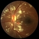 Encephalitis with Retinal Cotton Wool Spots Encephalitis with Retinal Cotton Wool Spots