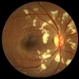 Encephalitis with Retinal Cotton Wool Spots Encephalitis with Retinal Cotton Wool Spots