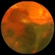 Proliferative Diabetic Retinopathy with Severe Subhyaloid Hemorrhage Proliferative Diabetic Retinopathy with Severe Subhyaloid Hemorrhage