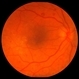 Proliferative Diabetic Retinopathy with Severe Subhyaloid Hemorrhage Proliferative Diabetic Retinopathy with Severe Subhyaloid Hemorrhage