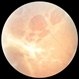 Retinoschisis/Retinal Detachment with Outer Layer Holes Retinoschisis/Retinal Detachment with Outer Layer Holes