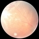 Retinoschisis/Retinal Detachment with Outer Layer Holes Retinoschisis/Retinal Detachment with Outer Layer Holes