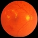 Nonproliferative Diabetic Retinopathy with Clinically Significant Macular Edema and Circinate Lipid Ring Nonproliferative Diabetic Retinopathy with Clinically Significant Macular Edema and Circinate Lipid Ring