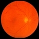 Nonproliferative Diabetic Retinopathy with Clinically Significant Macular Edema and Circinate Lipid Ring Nonproliferative Diabetic Retinopathy with Clinically Significant Macular Edema and Circinate Lipid Ring