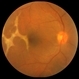 Choroidal Rupture Choroidal Rupture