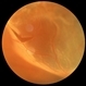 Acute Retinal Detachment with Posterior Tear Acute Retinal Detachment with Posterior Tear