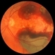 ARMD with Subretinal Hemorrhages and Macular Scarring ARMD with Subretinal Hemorrhages and Macular Scarring