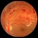 Retinal Vasculitis with Hemorrhages and Cotton Wool Spots Retinal Vasculitis with Hemorrhages and Cotton Wool Spots