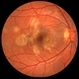 Acute Multifocal Placoid Pigment Epitheliopathy Placoid Lesions