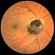 Optic Disc Melanocytoma Optic Disc Melanocytoma
