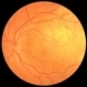 Breast Cancer Metastatic Lesion to Choroid Breast Cancer Metastatic Lesion to Choroid